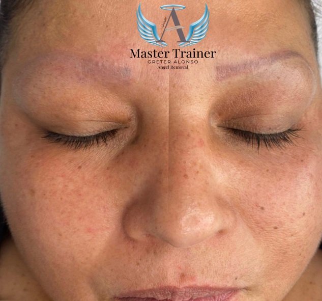 tattoo removal training tattoo removal training near me